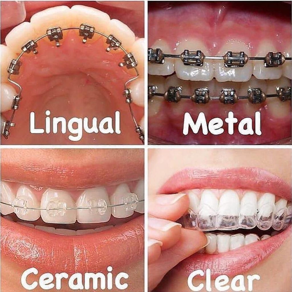 Orthodontic treatment