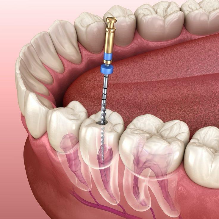 Endodontic treatments