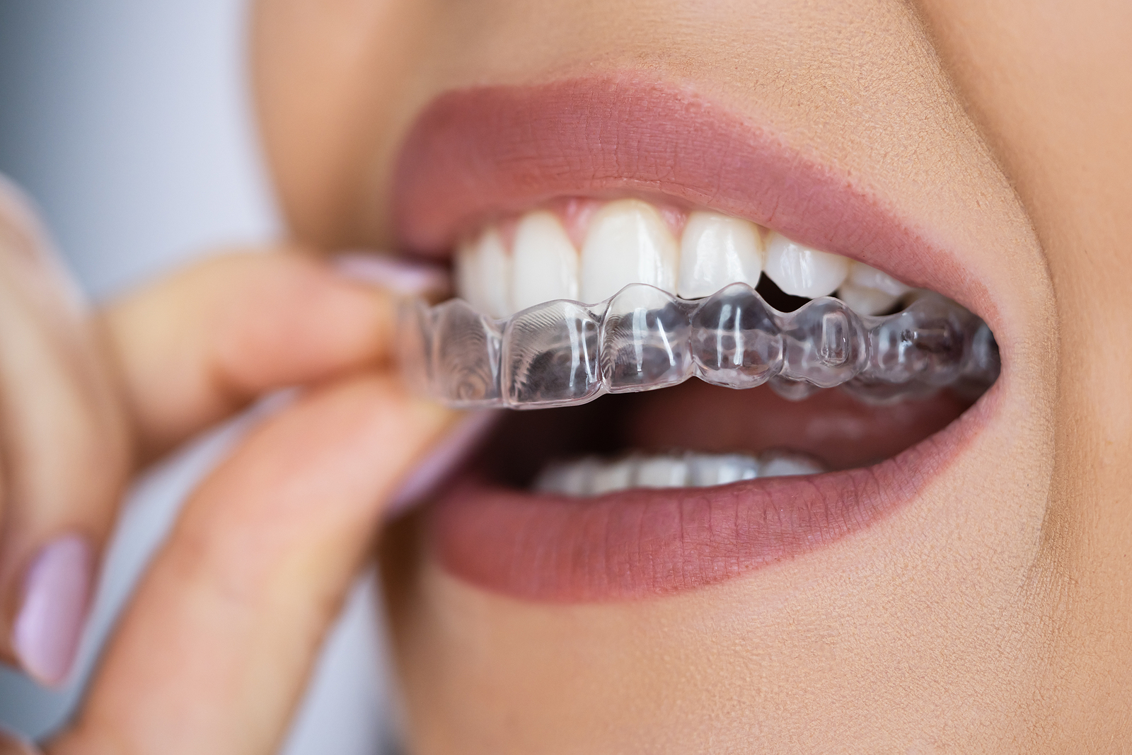 Aligners