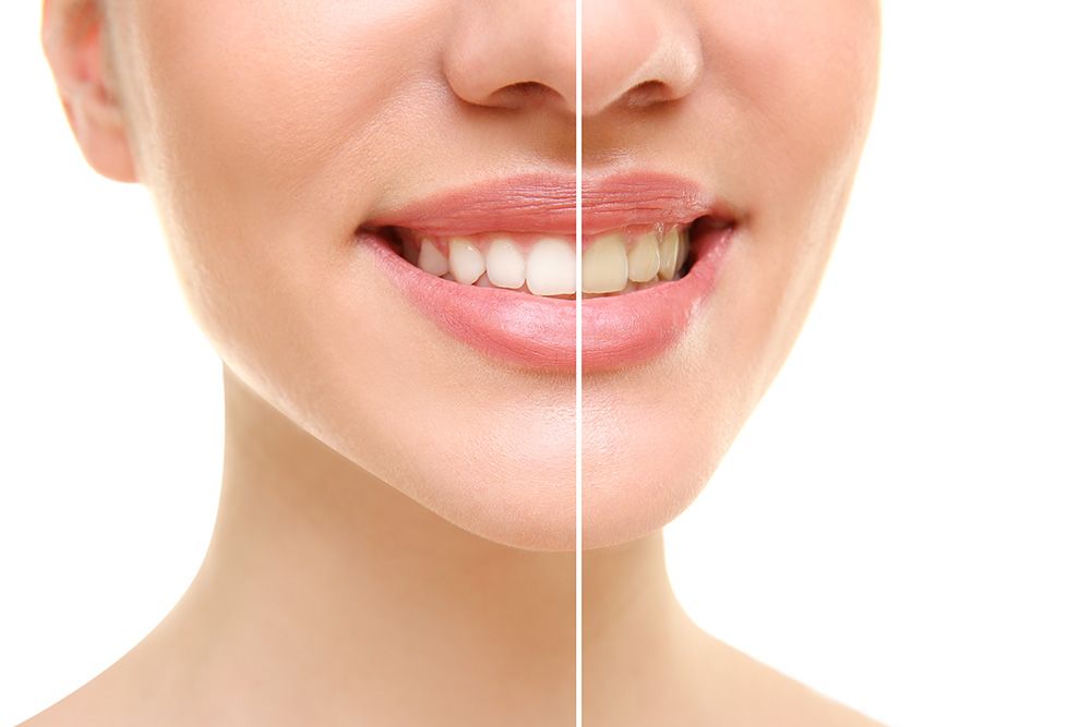 Teeth Restoration