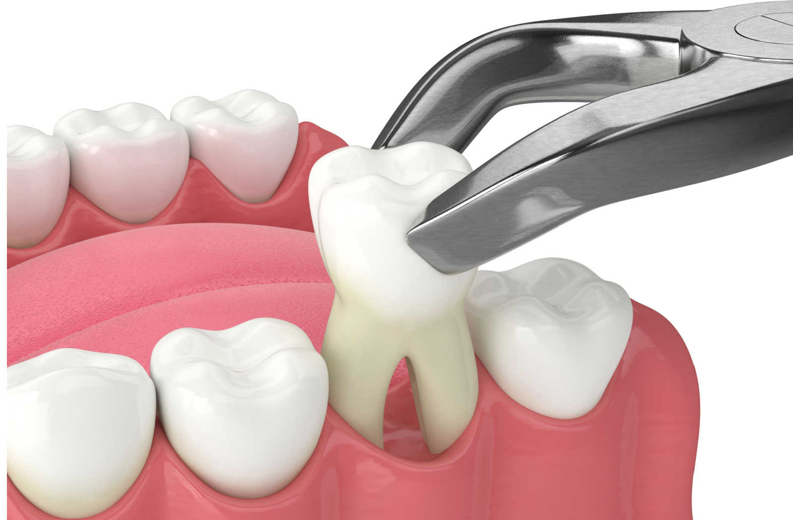 Teeth extraction