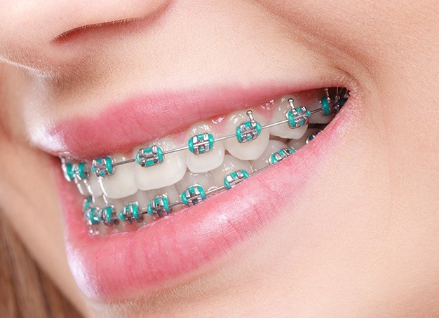 Braces Treatment