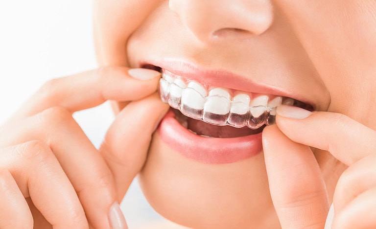 Aligner
