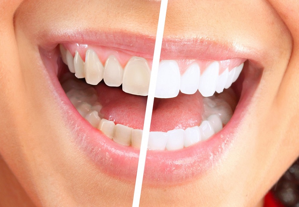 Dental Cleaning